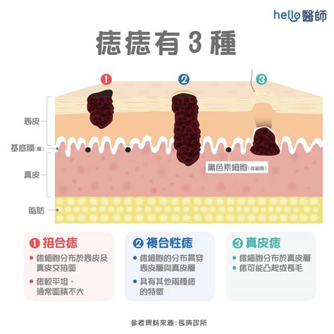 腋下長痣|腋下不規則痣長毛，是否需要切除？